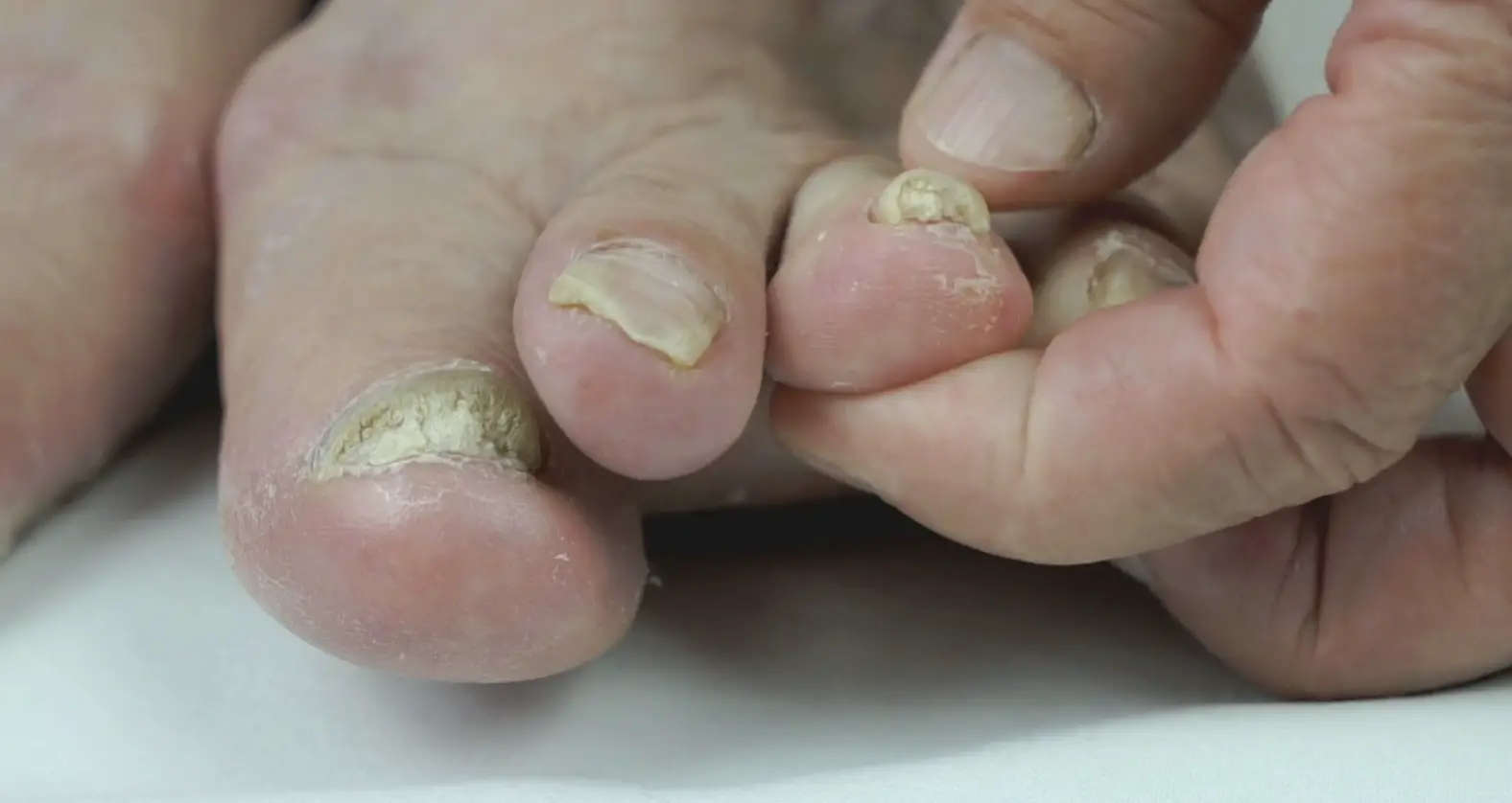 How to treat toe nail fungus