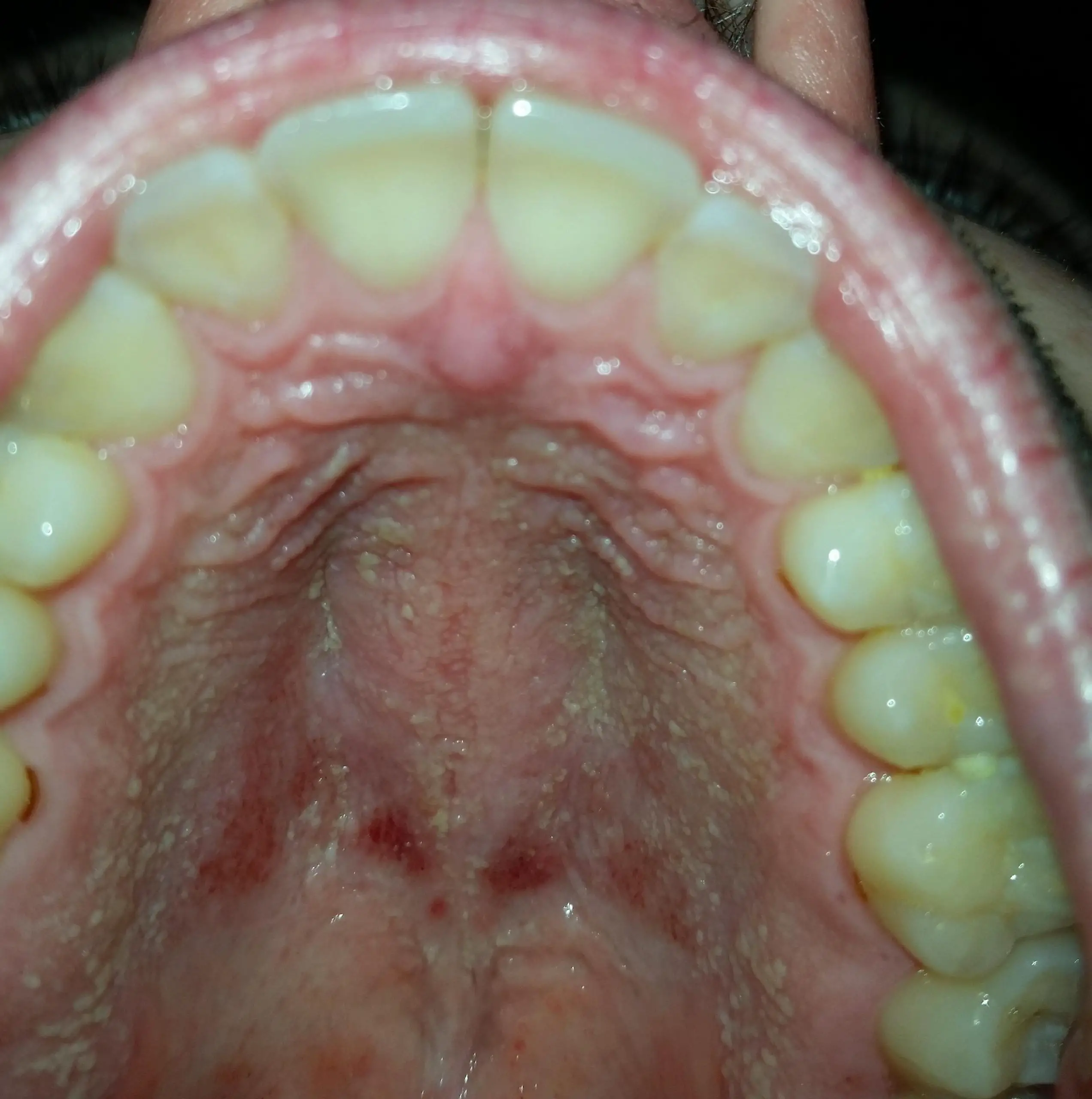 Rash on roof of mouth. Any advice appreciated : Dentistry